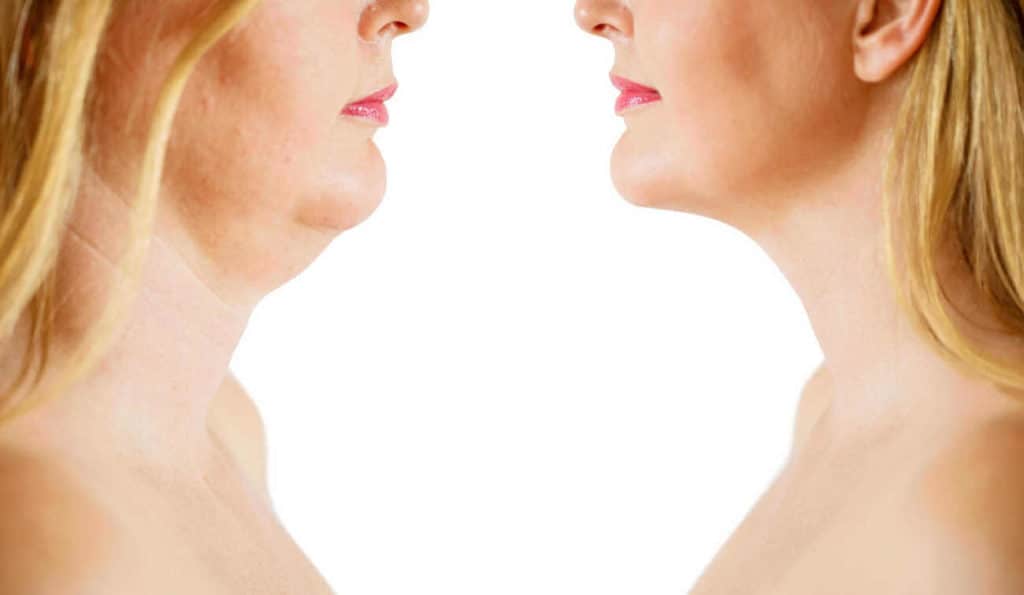 Double Chin treatment Ledbury before and after results