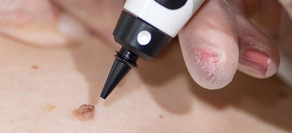 After Skin Tag Removal Ledbury