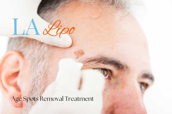 What Are the Most Effective Treatments for Age Spots Ledbury?