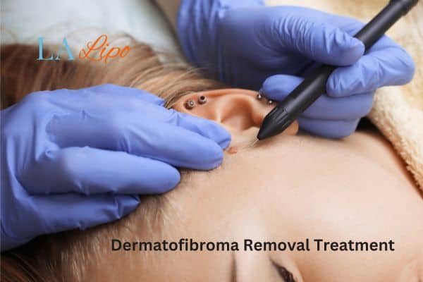 Dermatofibroma Removal Treatment Ledbury