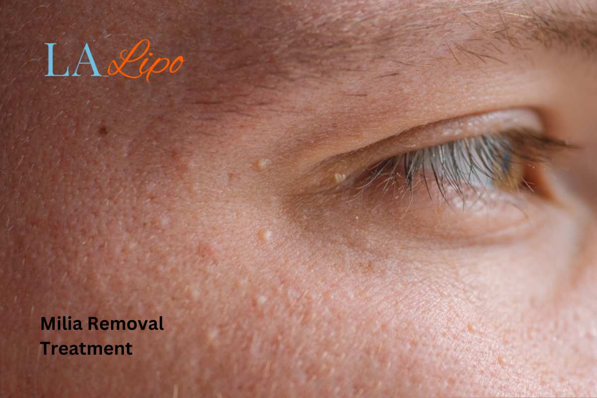 Cryopen Milia Removal: Is It the Easiest and Safest Option Ledbury?