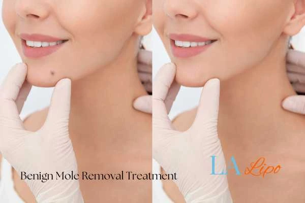 Before-and-after results following benign mole-removal treatment Ledbury