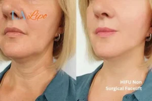 hi-fu for wrinkles Ledbury before and after results