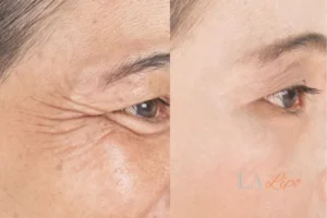 Before and after results of woman - HI-fu wrinkles reduction treatment Ledbury