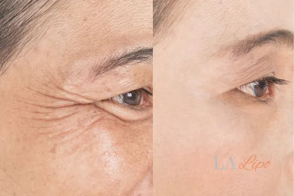 Before and after results of woman - HI-fu wrinkles reduction treatment Ledbury