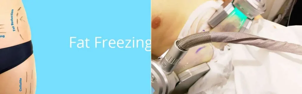Fat freezing Ledbury on multiple areas of the body