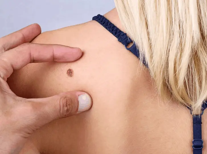 woman having mole removal Ledbury consultation before treatment.