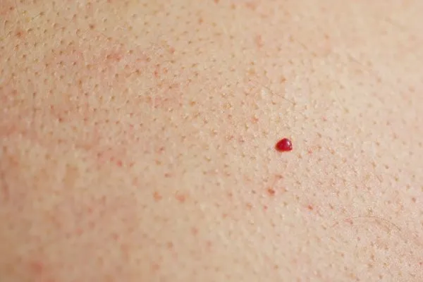 close up of a cherry angioma Ledbury