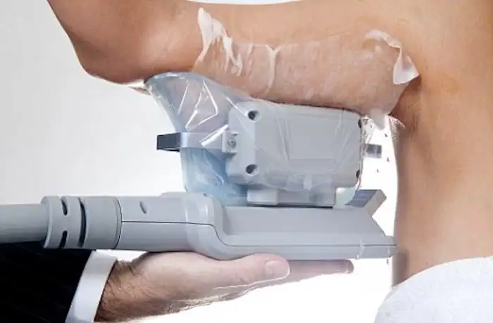Picture of fat freezing Ledbury on the upper arms.