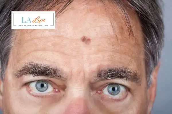 Solar Lentigo Removal Ledbury image of man with mark on his forehead