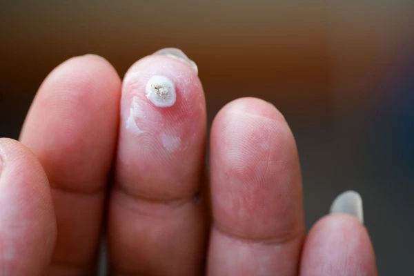 wart on person finger - cryotherapy to treat from LA LIPO Ledbury