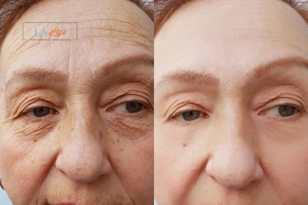 The powerful benefits of Morpheus8 Treatment Ledbury - Call Our team today!