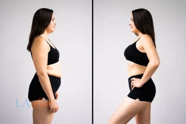 Picture of womans before and after using LA-EMS body sculpting to improve her core strength Ledbury