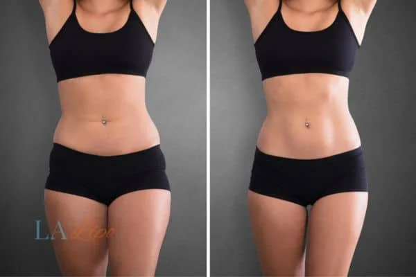 before and after results of non-surgical treatment to help a woman's body image and mental health Ledbury