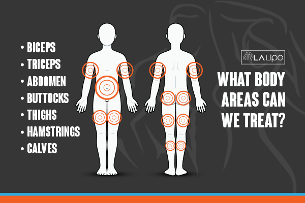 Diagram to show areas you can have LA-EMS Body Sculpting Treatment Ledbury