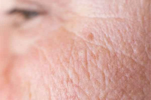 close up picture of a woman's face showing an age spot Ledbury
