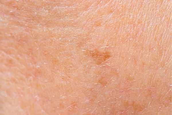 close up picture of age spots Ledbury