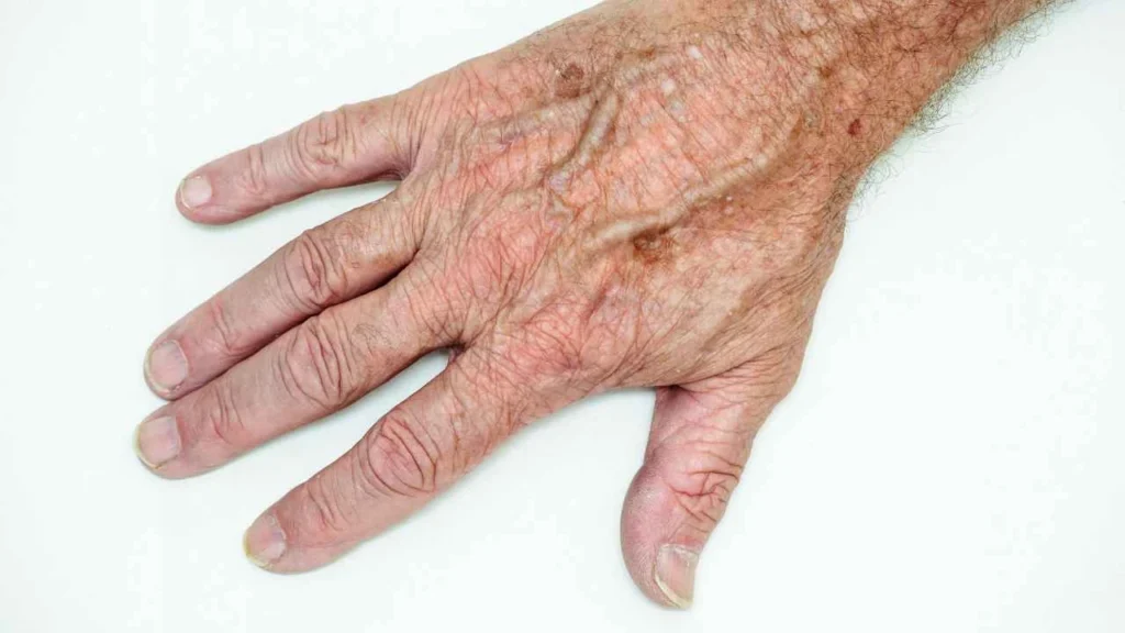 Male hand showing age spot Ledbury