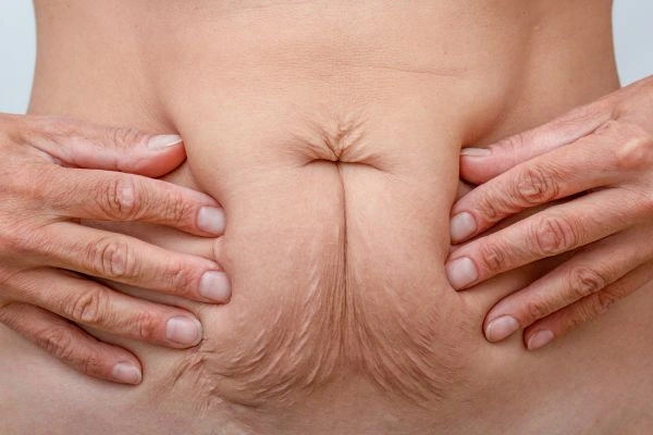 Image of a woman's stomach with loose skin - example of skin tightening Ledbury options