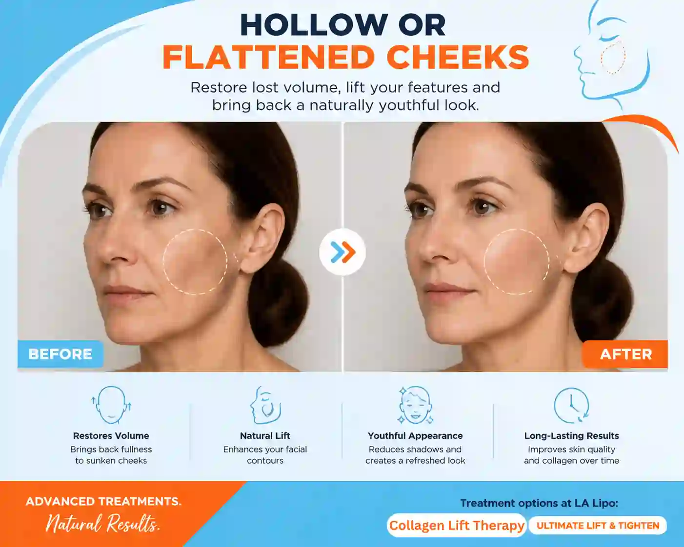 Sign #4: Hollow or Flattened Cheeks Ledbury