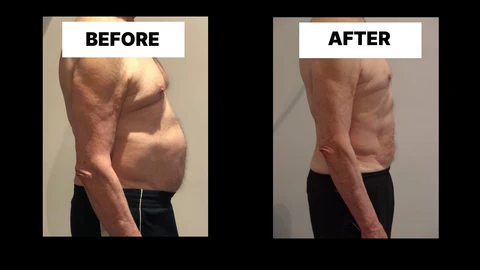 What Symptoms Can Diastasis Recti Cause in Men? Weak Core, Back Pain and Poor Posture Ledbury